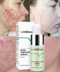 ANTI-ACNE SOLUTION FACE ESSENCE REPAIR PIMPLES SCARS DARK SPOTS WHITENING SKIN SHRINK PORES SERUM - Professional Results for EU Clinics