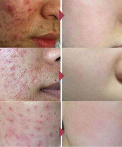 Alternative view of ANTI-ACNE SOLUTION FACE ESSENCE REPAIR PIMPLES SCARS DARK SPOTS WHITENING SKIN SHRINK PORES SERUM - Professional Results for EU Clinics