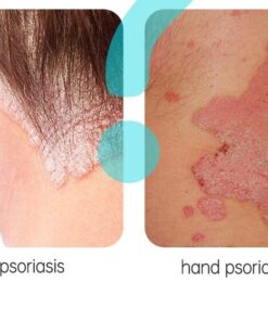 Alternative view of HERBAL PSORIASIS SKIN CREAM OINTMENT ANTIBACTERIAL GEL AGAINST ANTI-ITCH ECZEMA RASH URTICARIA DESQUAMATION TREATMENT - Professional Results for UK Clinics