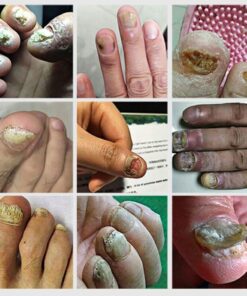 Alternative view of NAIL TREATMENT - Professional Results for UK Clinics